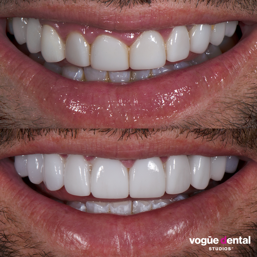 Before and after old composites with porcelain veneers at Vogue Dental Studios - front teeth view Michael.