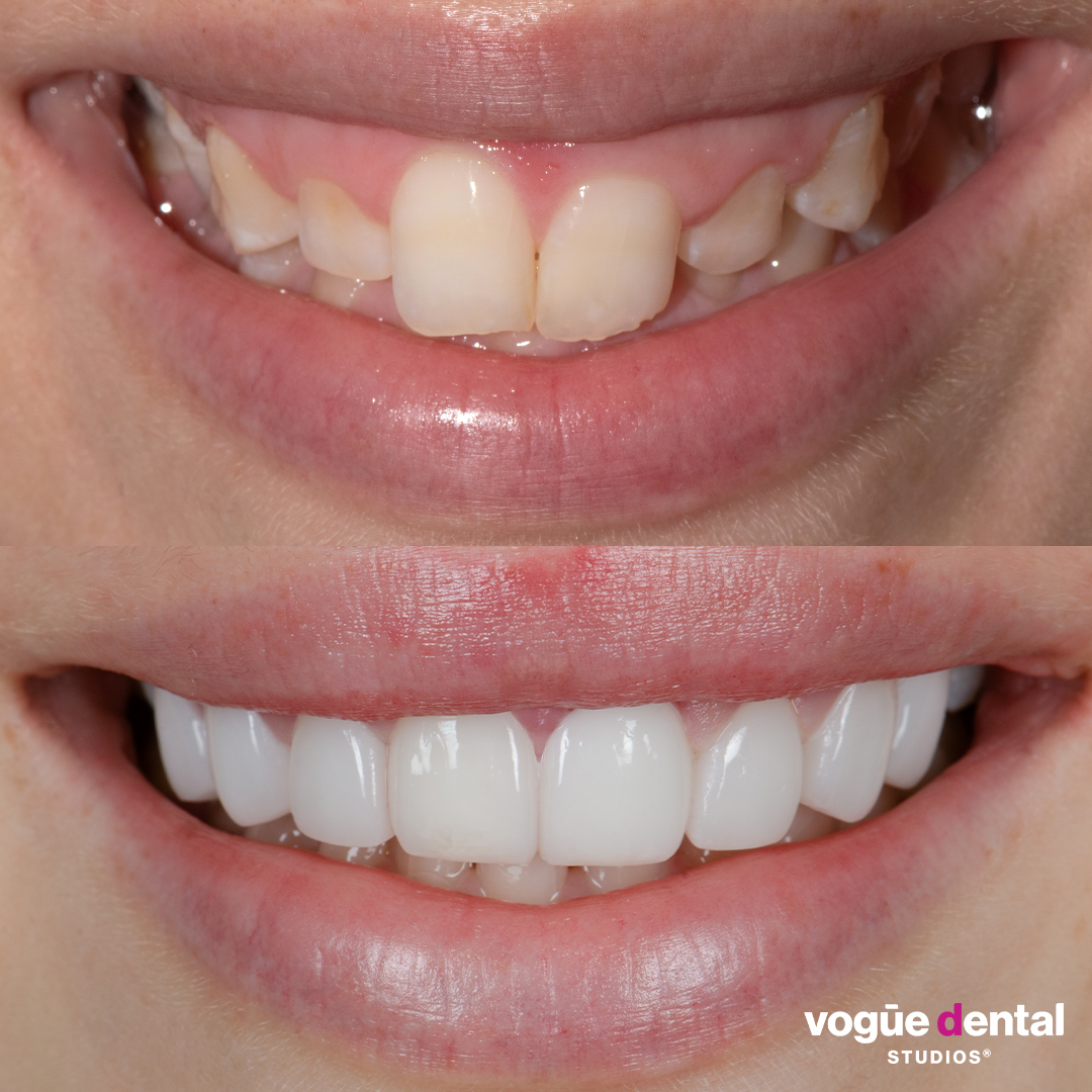 Before and after with Picasso Ultra Hybrid veneers at Vogue Dental Studios - front teeth view Lili. 