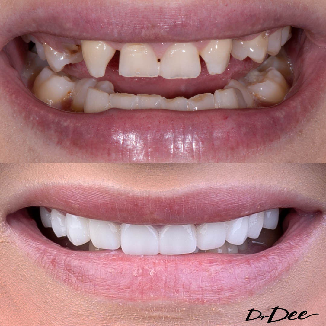 Shai before and after smile makeover for gappy smile at Vogue Dental Studios