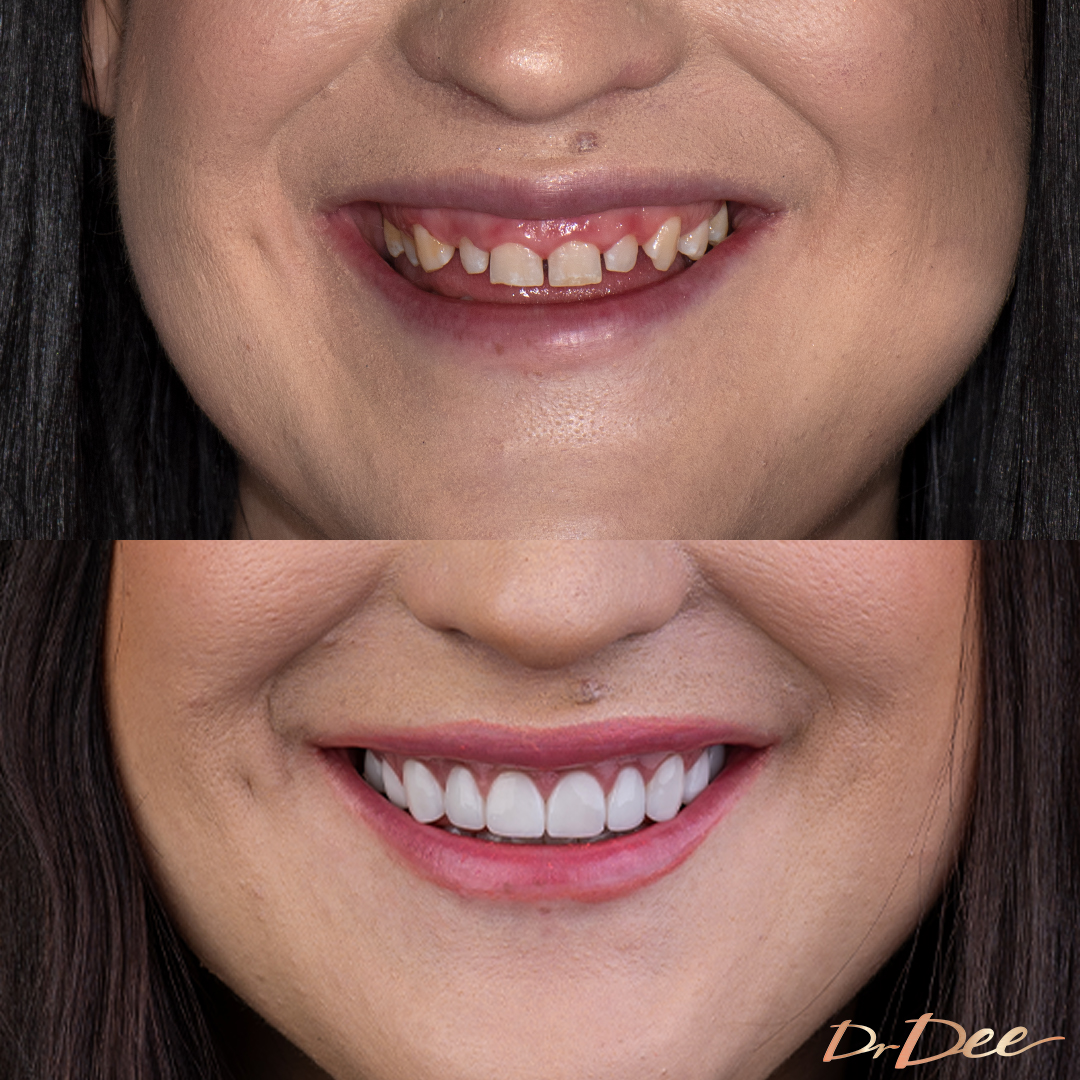 Marina gummy smile with gaps before and after veneers at Bring Back a Smile Foundation