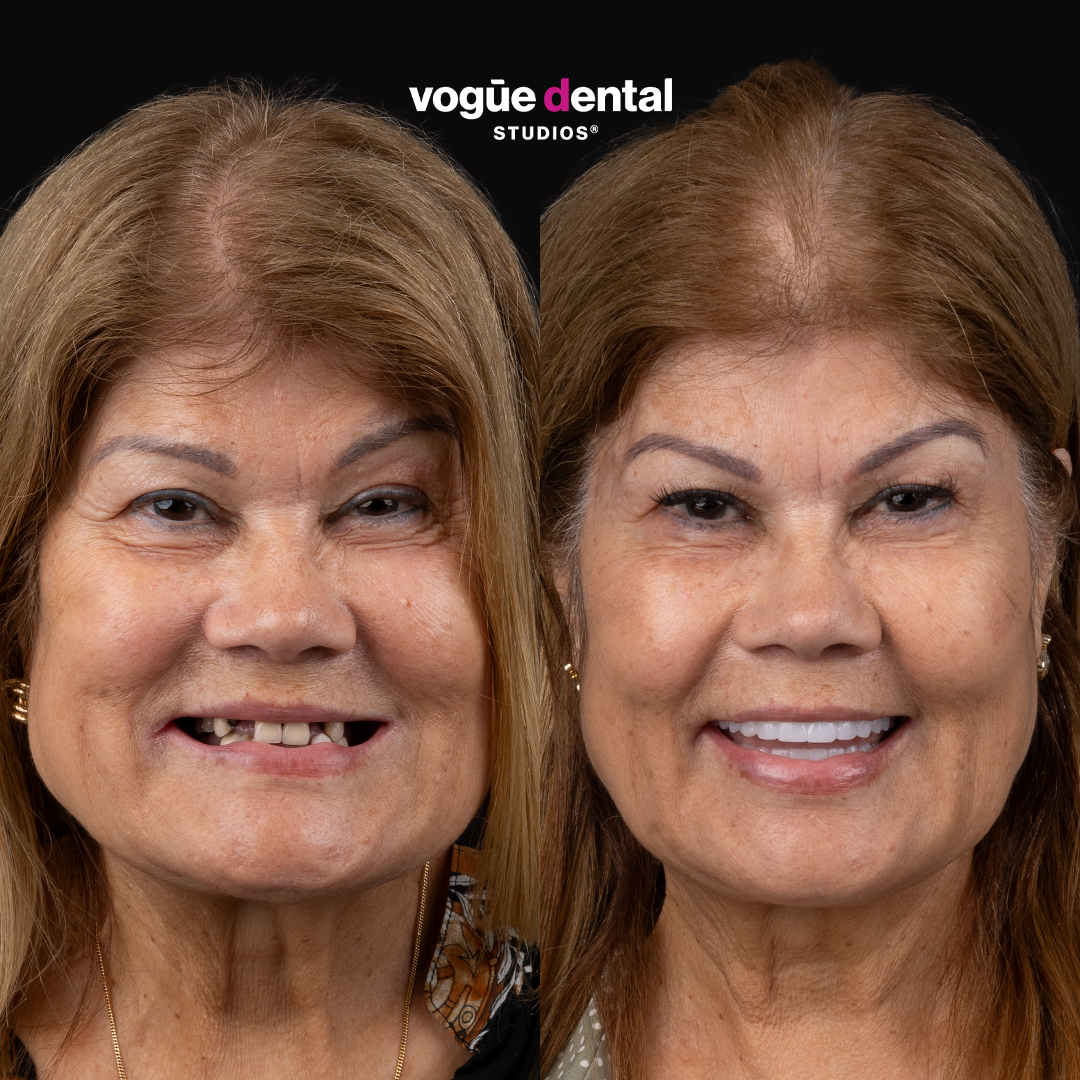 Before and after implant smile makeover at Vogue Dental Studios - front teeth view Doreen