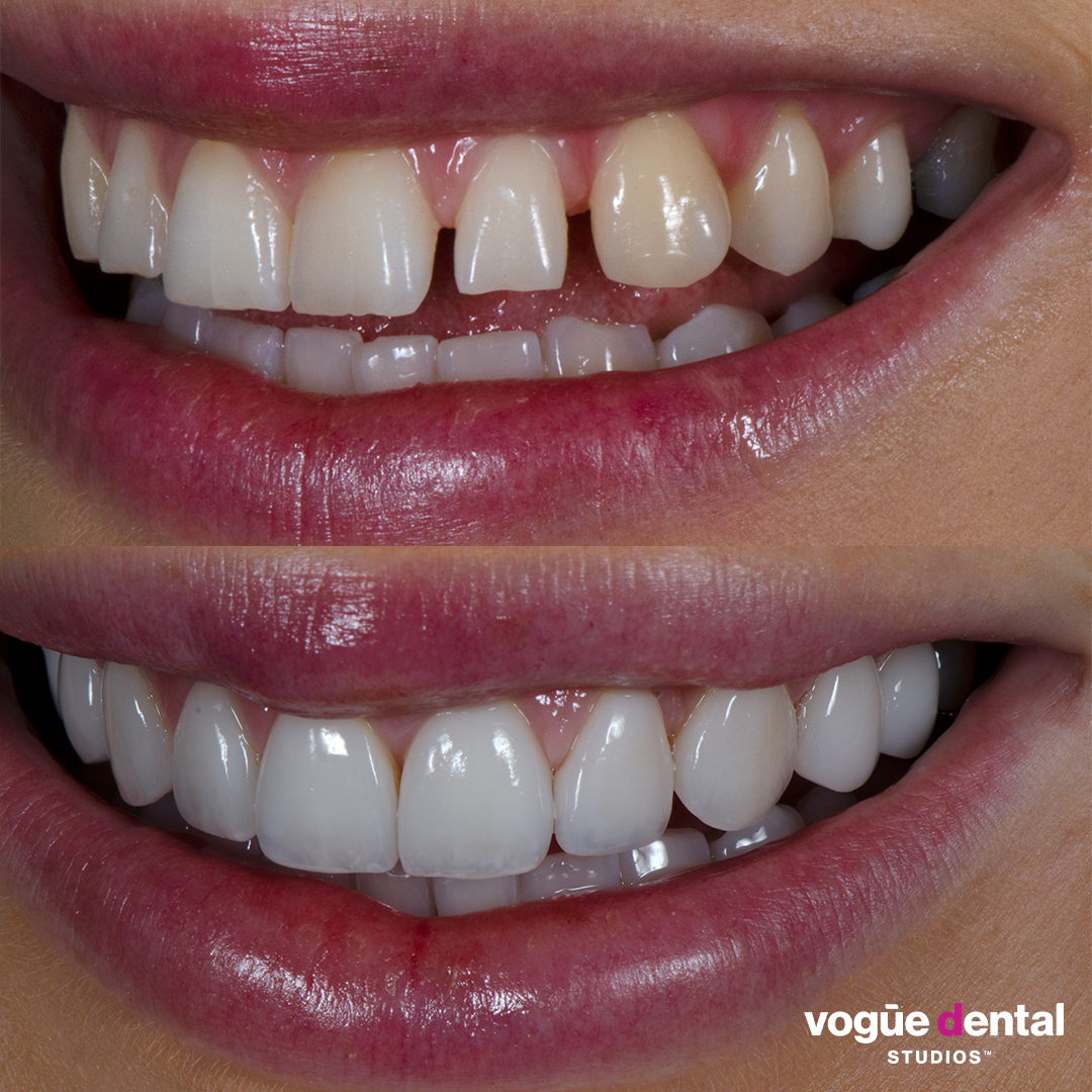 Before and after square teeth with porcelain veneers at Vogue Dental Studios - left teeth view Renee.