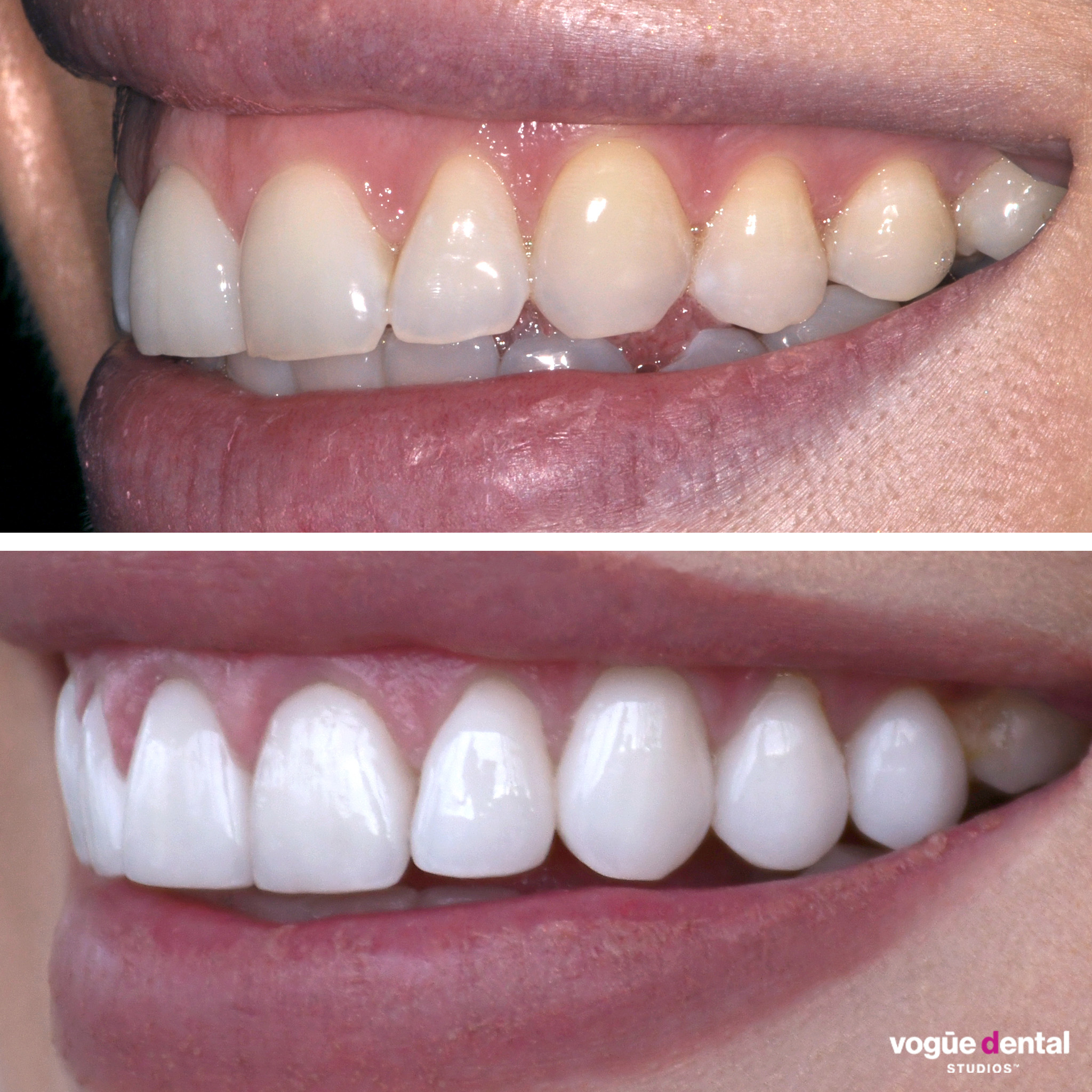 Before and after gummy smile and smile cant correction with porcelain veneers at Vogue Dental Studios - side view Cassie.