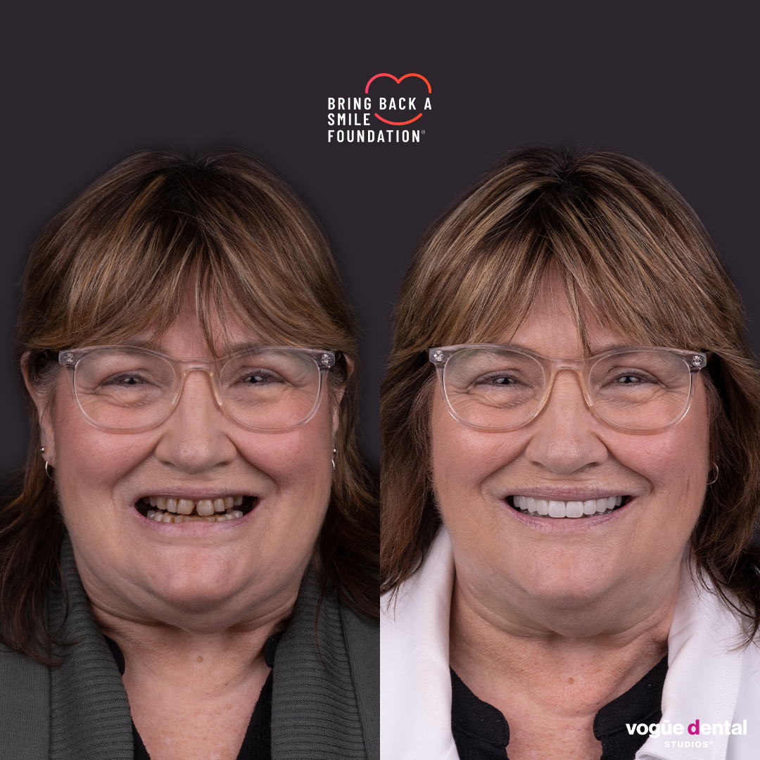 Judy smile restoration after stress vomiting at Bring Back a Smile Foundation