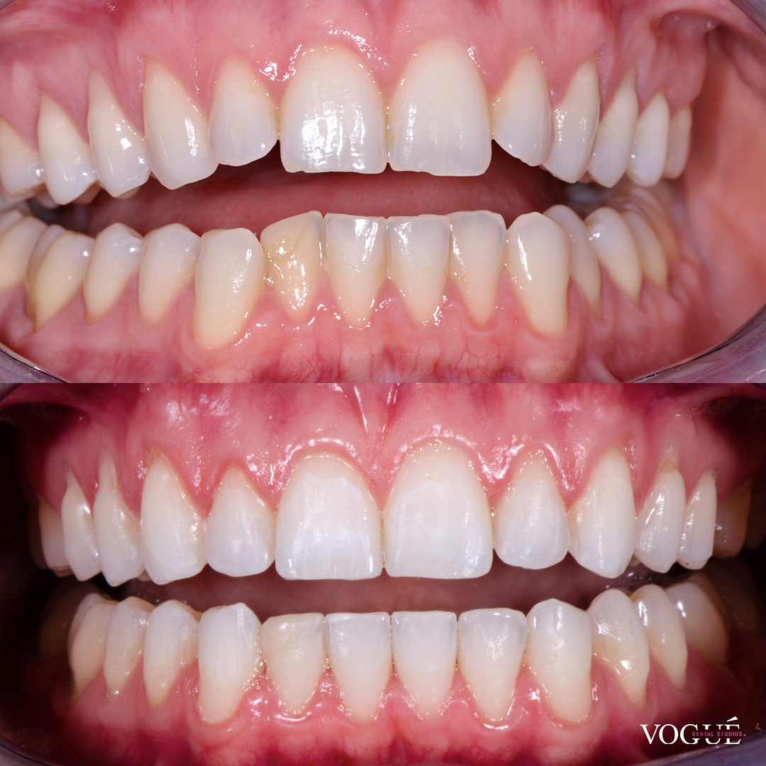 Before and after Invisalign Lite at Vogue Dental Studios - front retracted view Stefanie.
