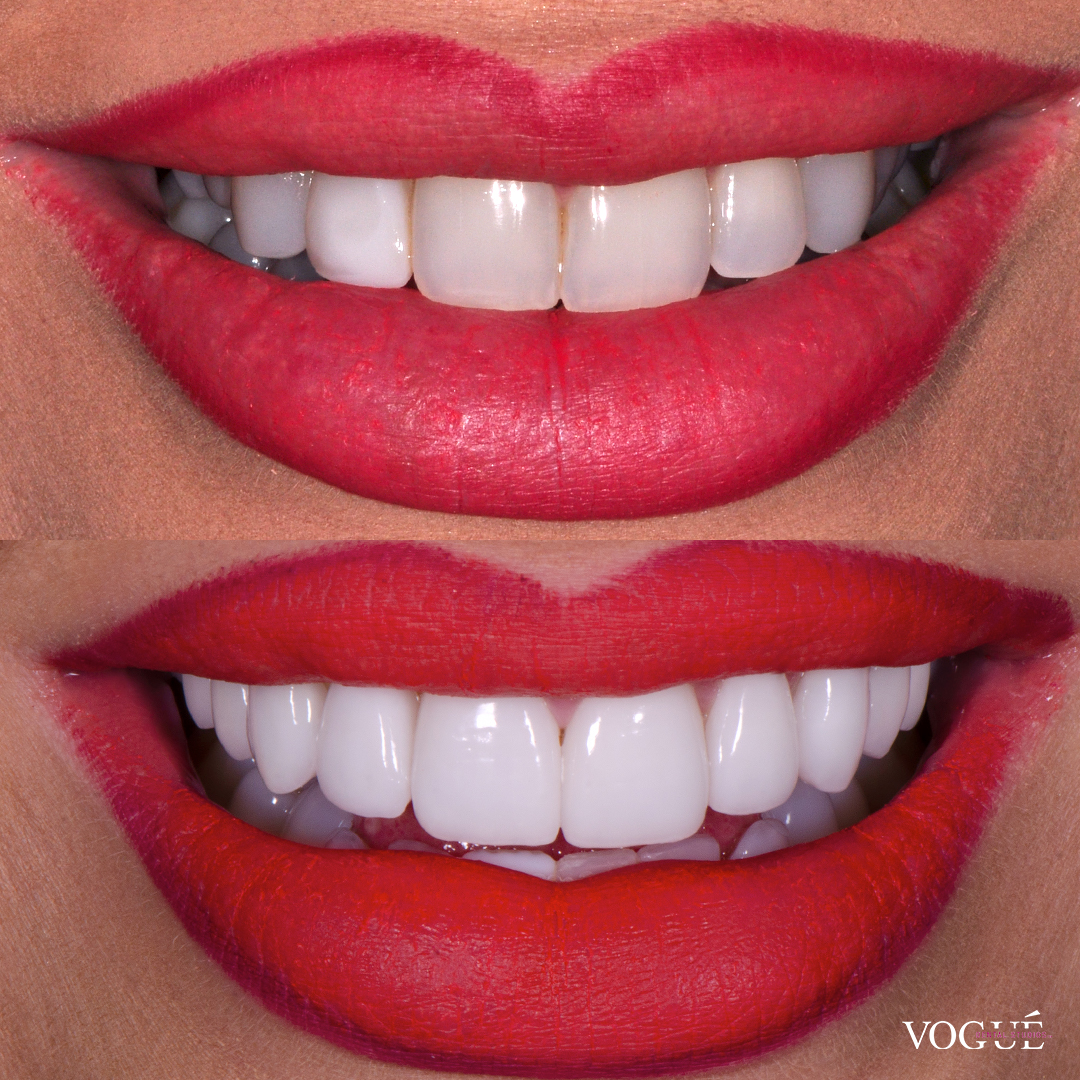 Before and after porcelain veneers at Vogue Dental Studios - front teeth view Sarah.
