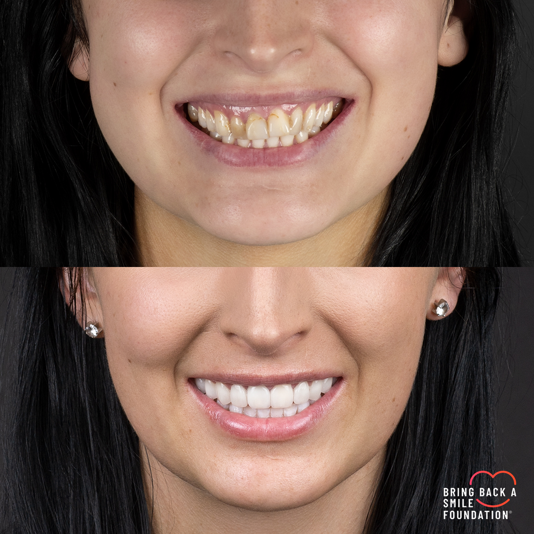 Shaan before after extraction braces and veneers with Bring Back a Smile Foundation