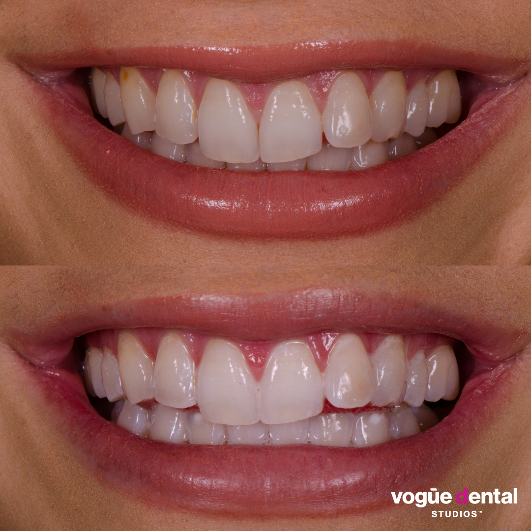 Before and after in-chair teeth whitening at Vogue Dental Studios - front teeth view Anna.