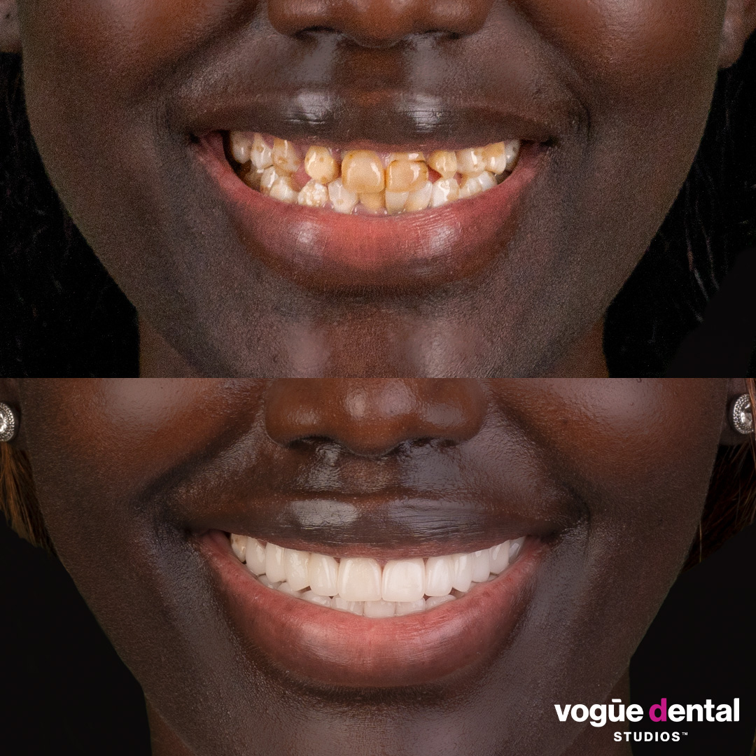 Isara a Bring Back a Smile Foundation receiver before and after dramatic smile makeover half face