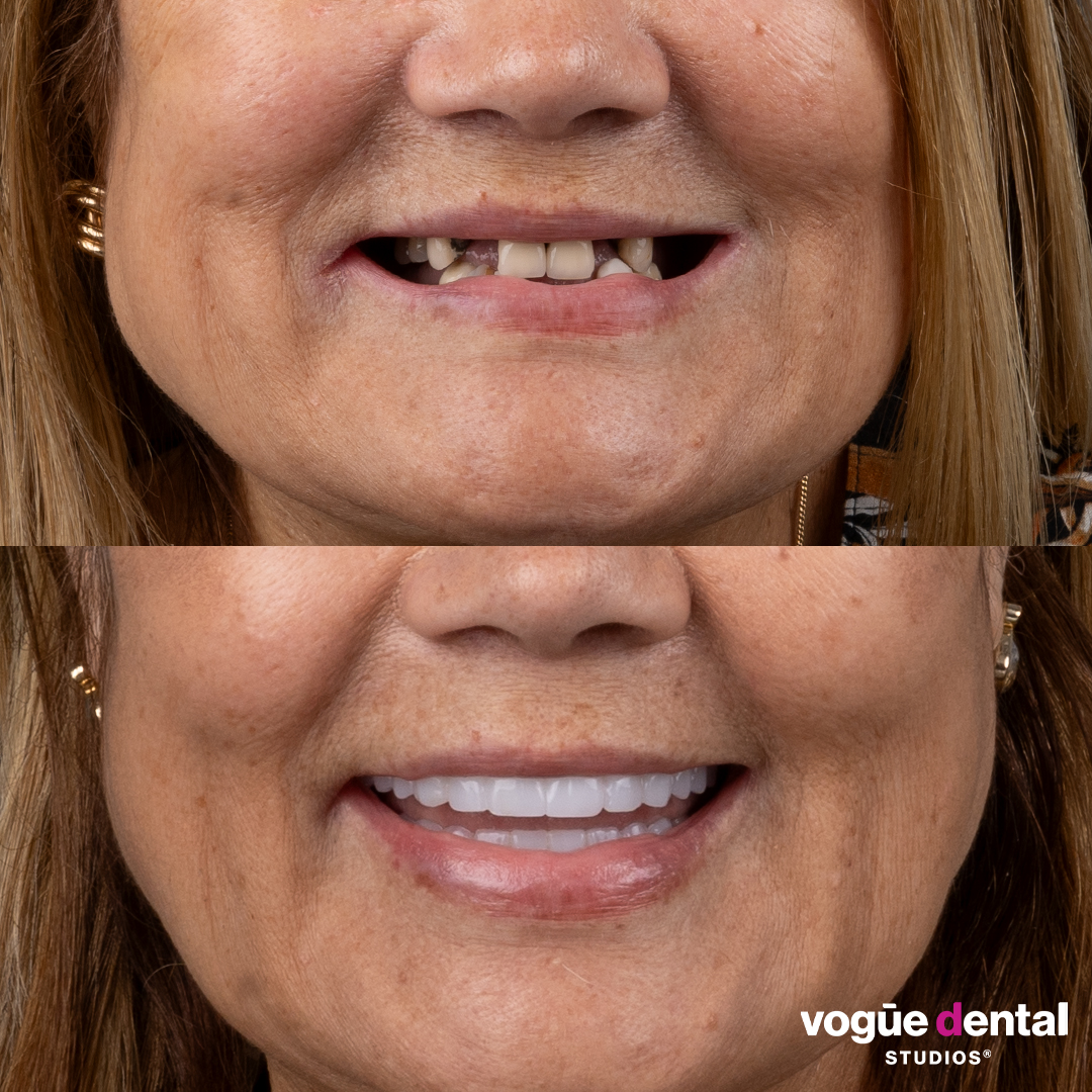 Before and after implant smile makeover at Vogue Dental Studios - cropped teeth view Doreen