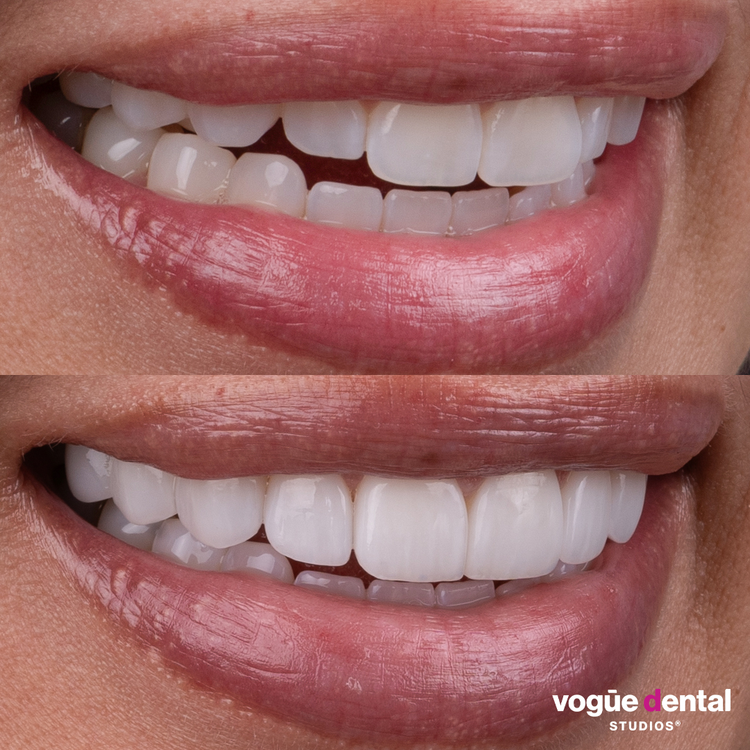 Before and after porcelain veneers at Vogue Dental Studios - side teeth view Angie.