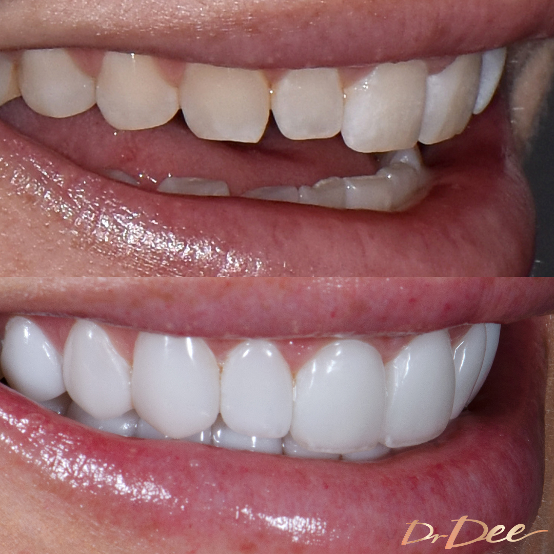 Melissa Rawson before and after Picasso Porcelain Veneers right teeth view.