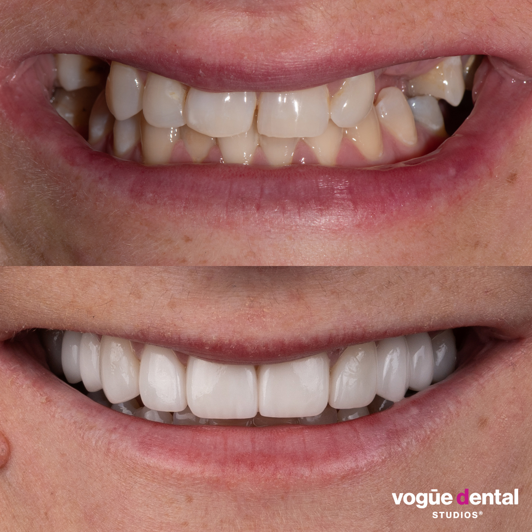 Before and after porcelain veneers at Vogue Dental Studios - front teeth view Amanda