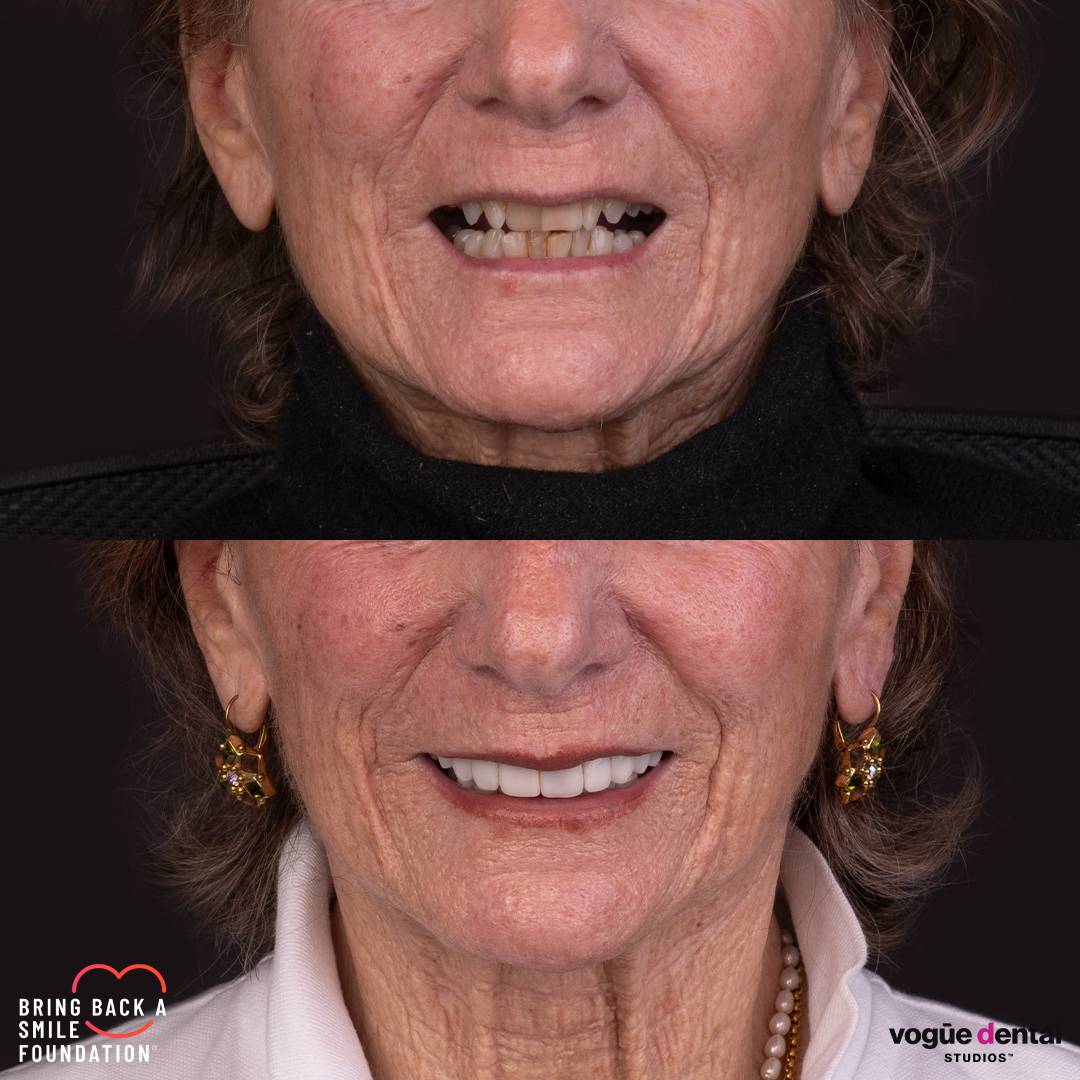 Anna, a cancer patient, before and after her smile makeover with porcelain veneers - half face view