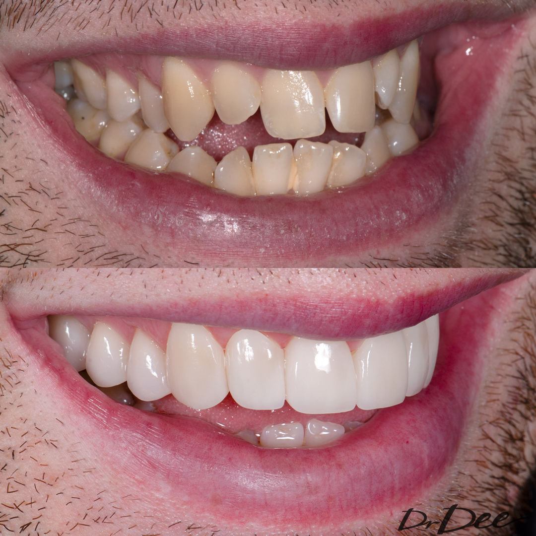 Patrick Dwyer from MAFS before and after veneers with a natural shade.