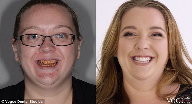 Jacinta Maguire, 27, from Christchurch, New Zealand, spent her entire life shying away from cameras and hiding her teeth after being born with severe enamel hypoplasia