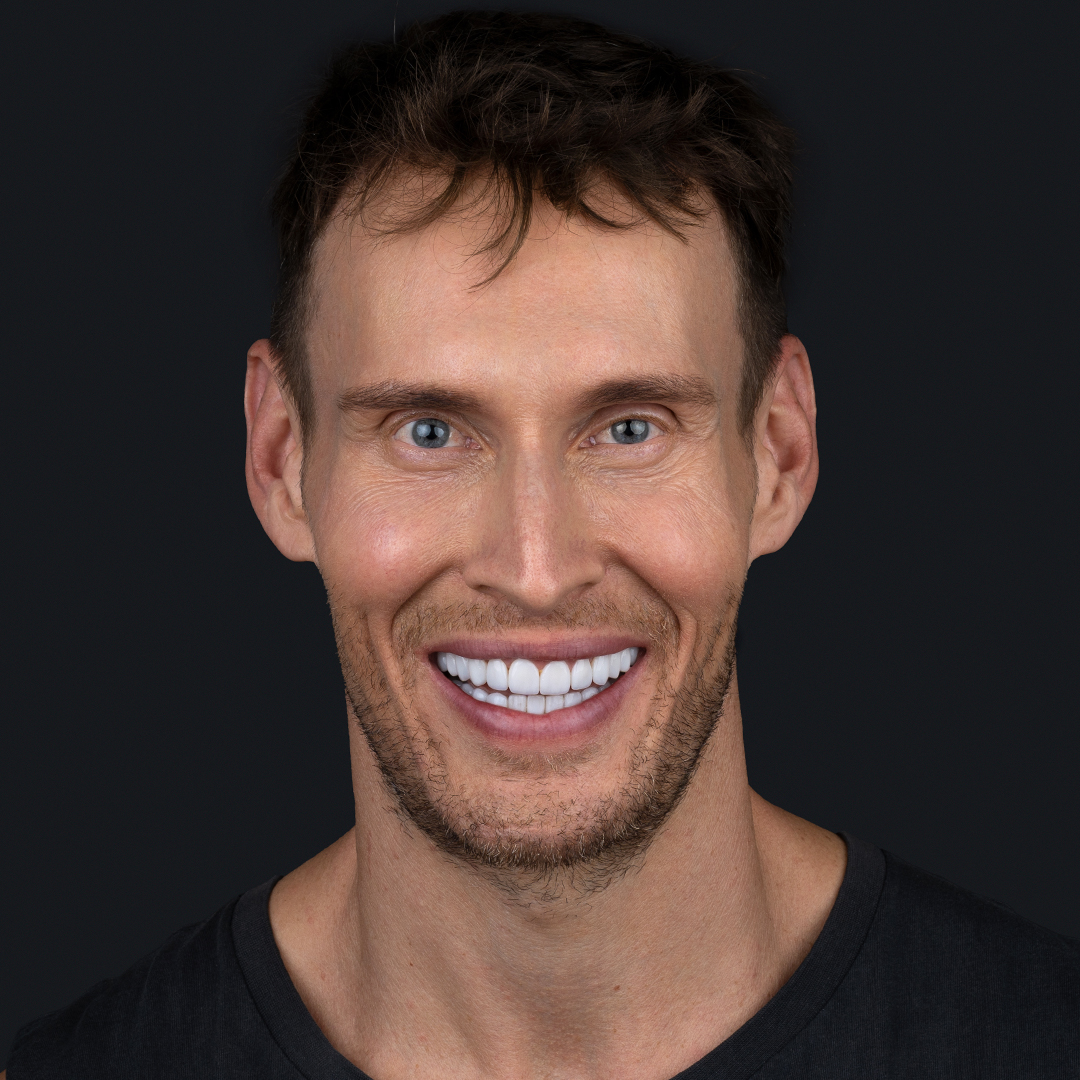 Luke Hines smile makeover with veneers and Invisalign