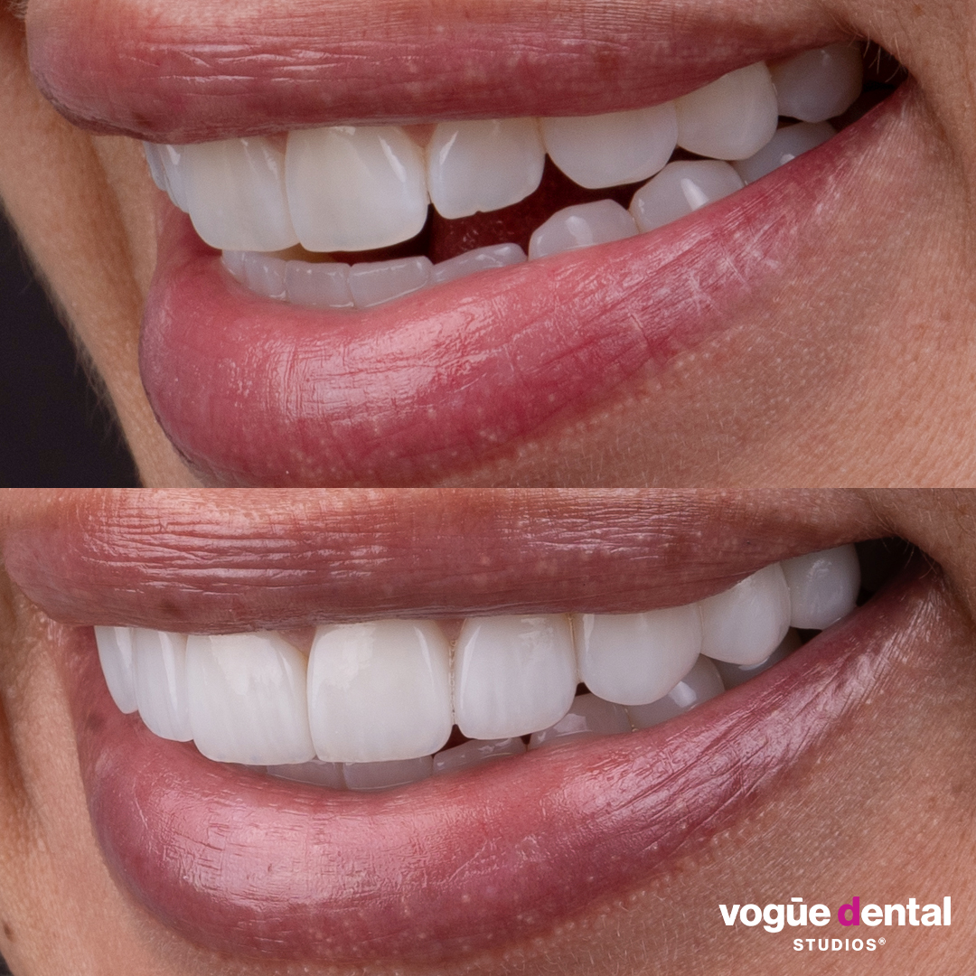 Before and after porcelain veneers at Vogue Dental Studios - side teeth view Angie.