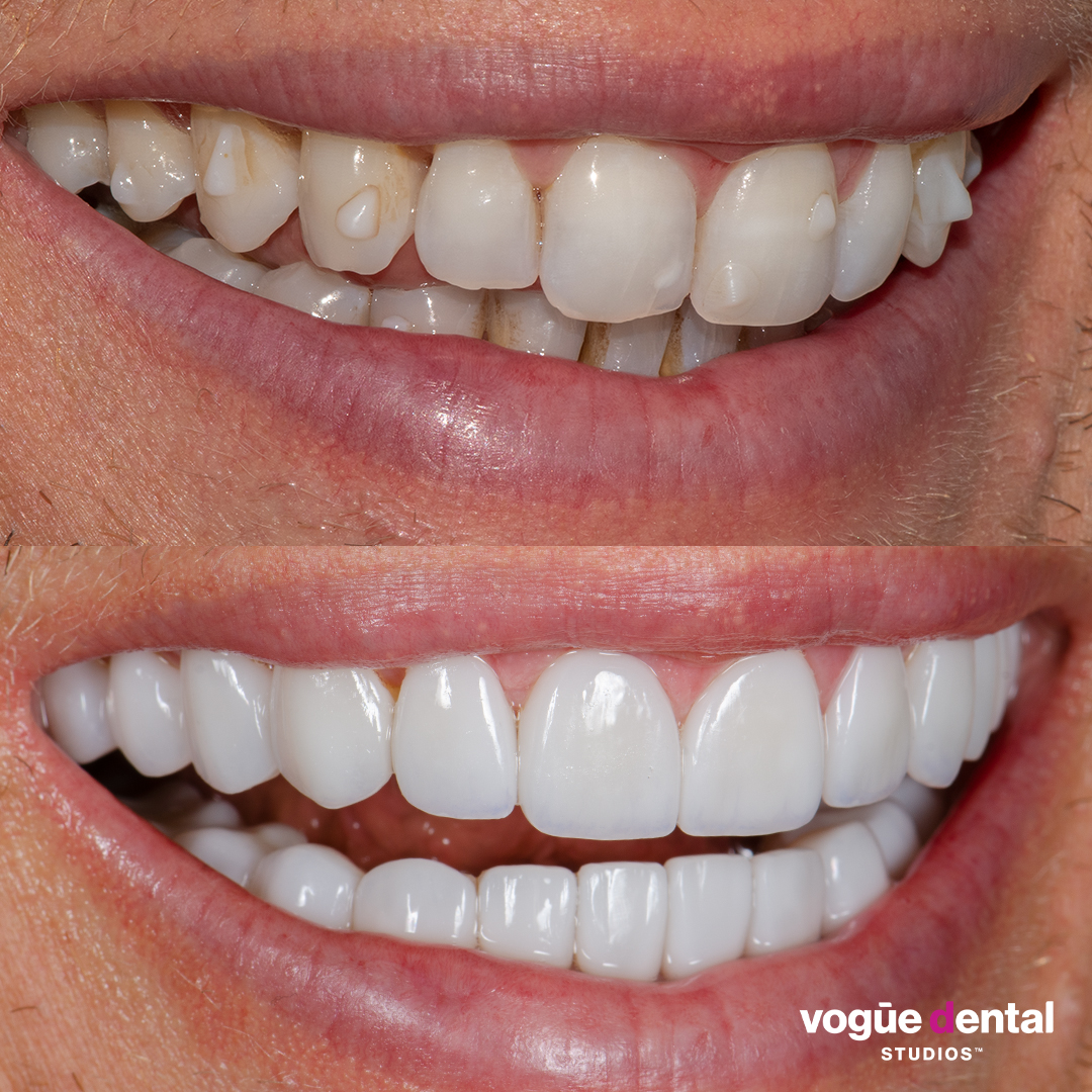 Before and after smile makeover Luke Hines - right smile view