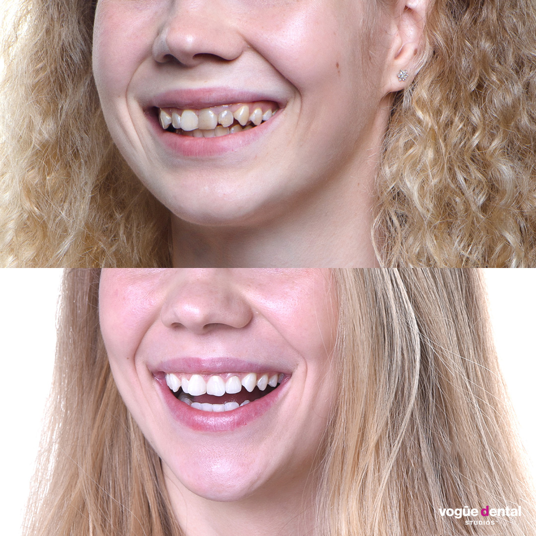 Before and after results of in-chair teeth whitening + x2 porcelain veneers at Vogue Dental Studios - Maria Esipova