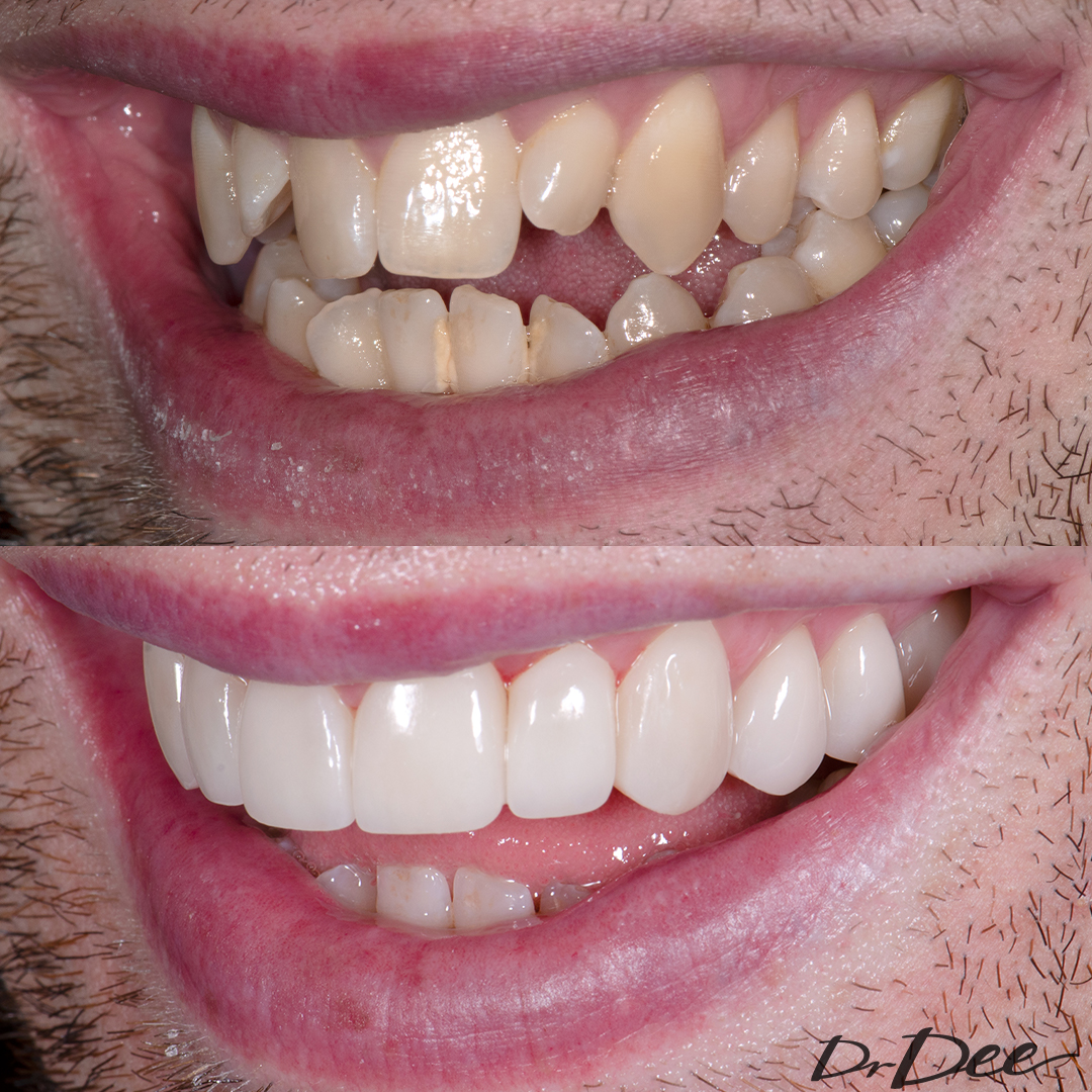 Patrick Dwyer uneven smile line before and after Picasso Porcelain Veneers left view.
