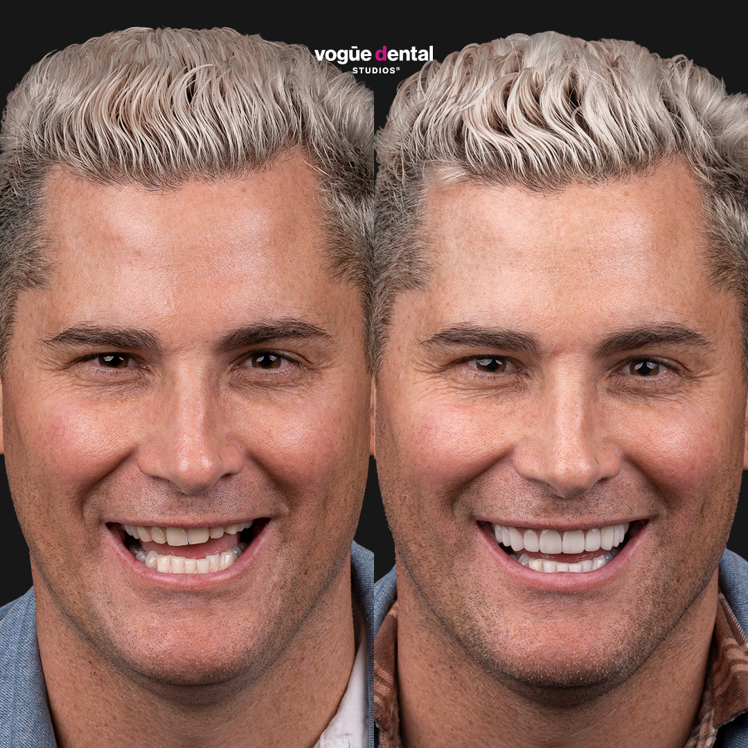 Jamie Doran smile makeover with porcelain veneers at Vogue Dental Studios