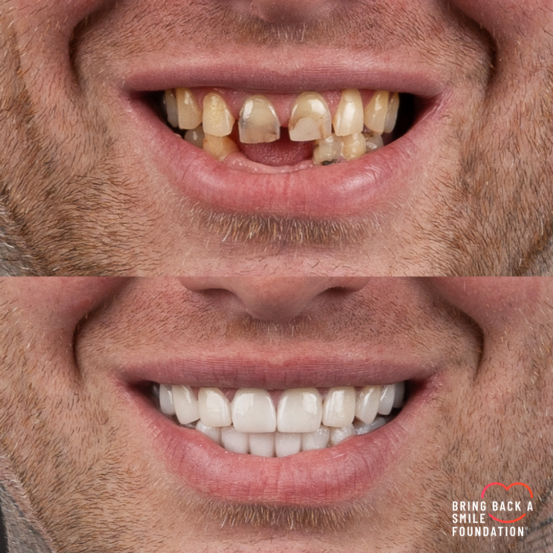 Before and after missing teeth with porcelain veneers at Vogue Dental Studios - front teeth view Josh