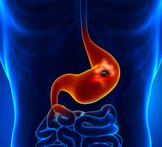 Featured image of post De lo invisible a lo urgente: la detección temprana del cáncer gástrico puede salvar vidas