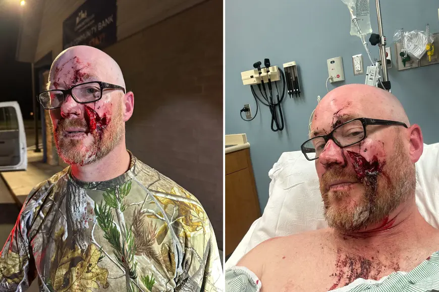 A hunter shows his facial wounds after a black bear attack. 