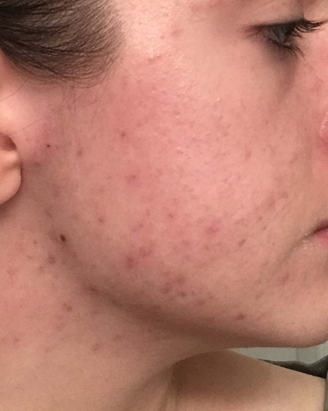 apostrophe acne reddit