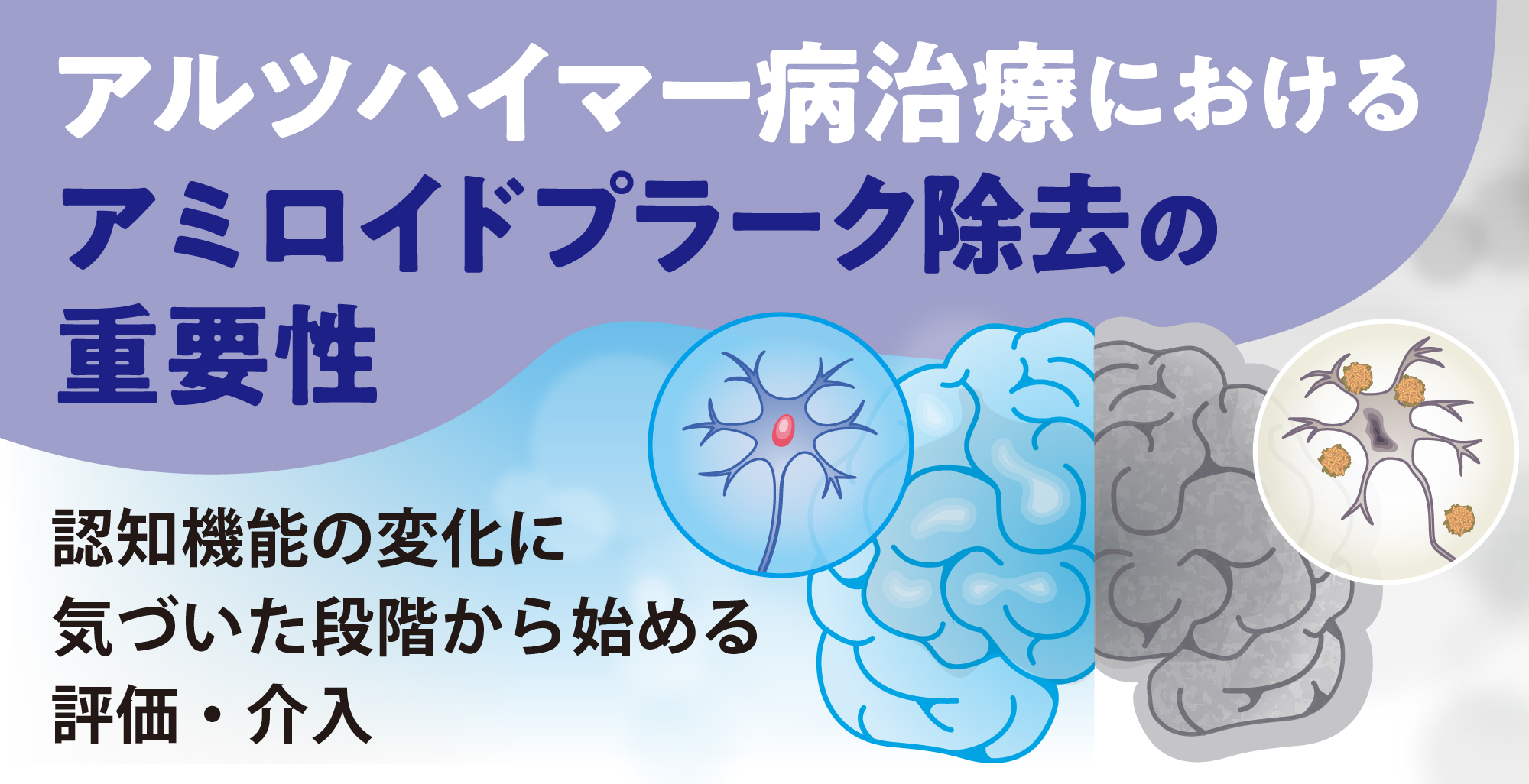 アルツハイマー病治療におけるアミロイドプラーク除去の重要性