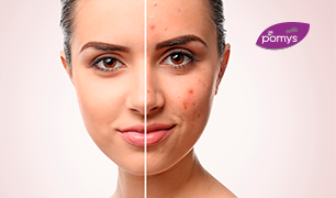 Como controlar el acne