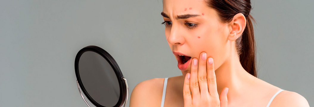 ¡Todo lo que necesitas saber sobre el acné! – Pomys