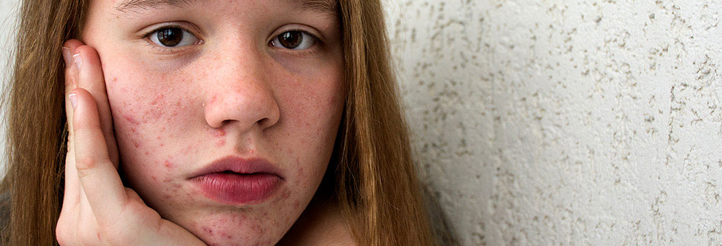 acne