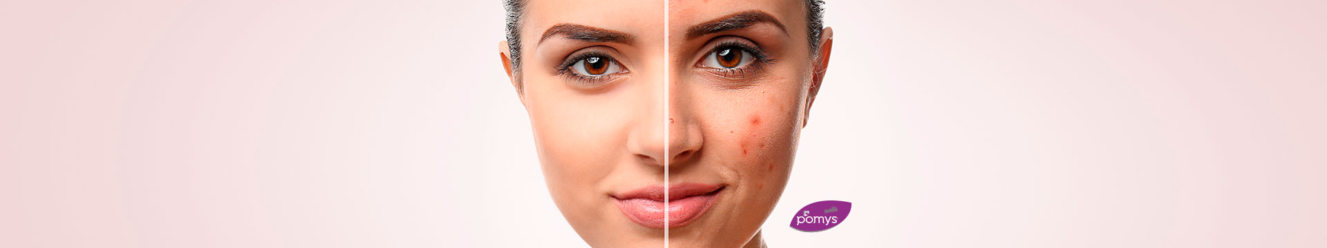 Controlar el acne