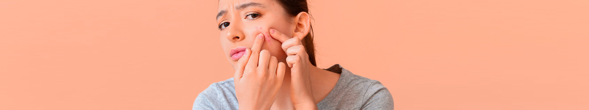 ¡Todo lo que necesitas saber sobre el acné! – Pomys