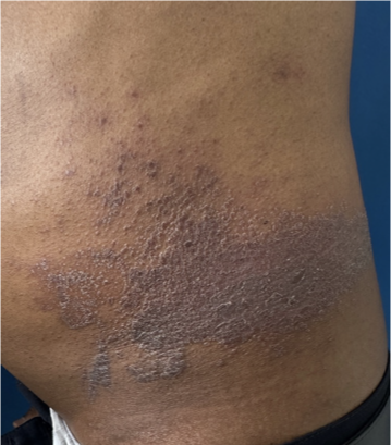 Ressecamento causado pela Dermatite Atópica