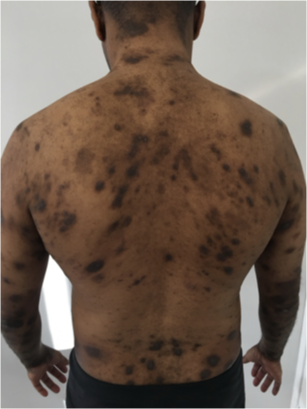 Dermatite Atópica em Peles Diversas