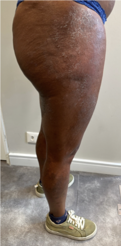 Impacto aparente da dermatite atópica em áreas comuns na pele diversa