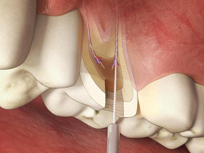Gaatjesbehandeling: Devitalisatie van tanden door wortelkanaalbehandeling