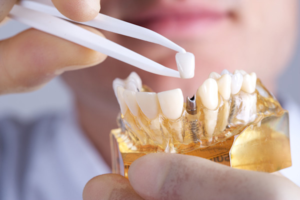 Meeting regulations for dental devices and implants with dentistry standards