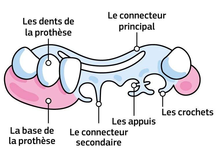 Une infographie présentant les différentes parties d'une prothèse partielle : la base de la prothèse, les dents de la prothèse, le connecteur principal, le connecteur secondaire, les appuis et les crochets.