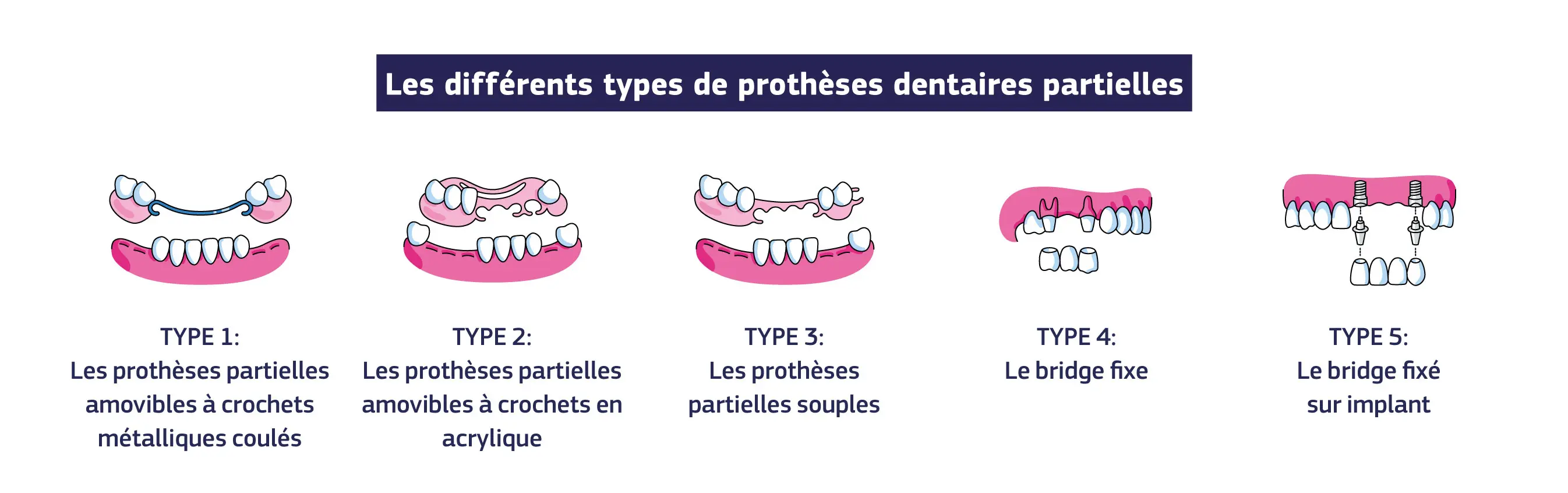 Types de prothèses partielles, Type 1 : Prothèses partielles amovibles à crochets métalliques coulés Type 2 : Prothèses partielles amovibles à crochets en acrylique Type 3 : Prothèses partielles souples Type 4 : Bridge fixe Type 5 : Bridge fixé sur implant
