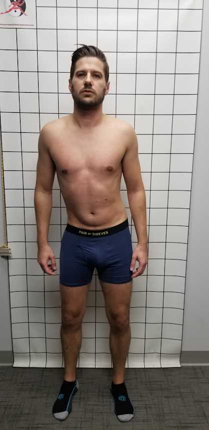 Correcting Severe Antalgic Posture & Gait
