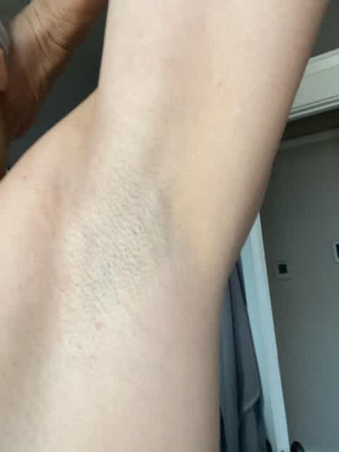 After only one treatment Axillary Web Syndrome with Sports Medicine Acupuncture