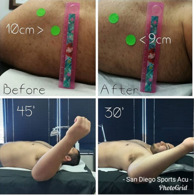 Before and After, Shoulder Pain, increased range of motion