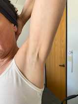 Treating Axillary Web Syndrome with Sports Medicine Acupuncture