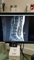 The Successful Treatment Of Sciatica And Low Back Pain With Sports Medicine Acupuncture®