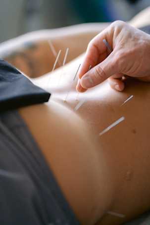 The Treatment of Back Pain with Sports Medicine Acupuncture
