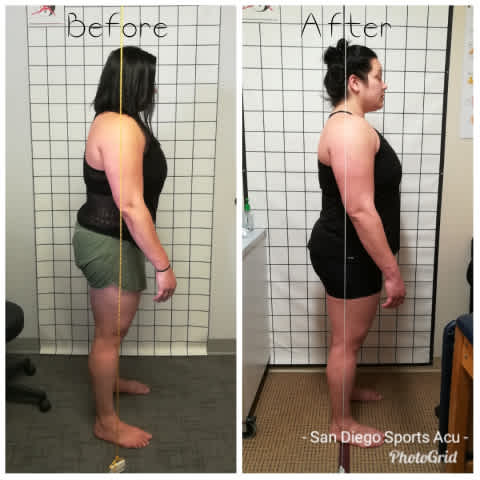 before and after postural alignment